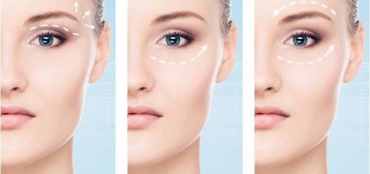 блефаропластика